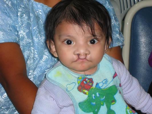 Cleft Lip Patient Stories from Guatemala 2009 Mission